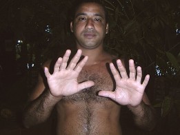 Un cubano de Baracoa tiene 24 dedos